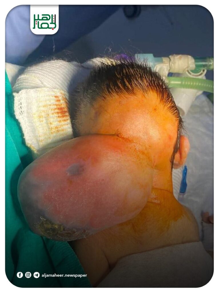 عملية جراحية نوعية في مشفى منبج الوطني تنقذ رضيعا بعمر خمسة أيام